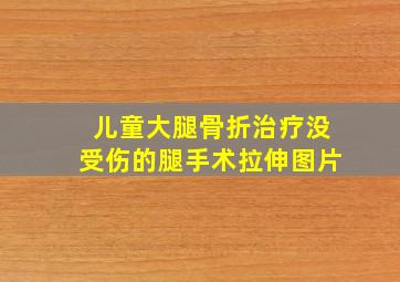 儿童大腿骨折治疗没受伤的腿手术拉伸图片