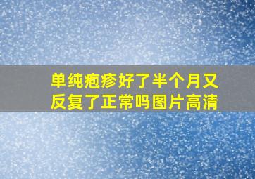 单纯疱疹好了半个月又反复了正常吗图片高清