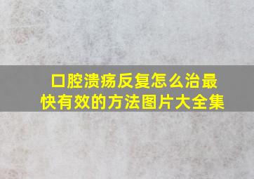 口腔溃疡反复怎么治最快有效的方法图片大全集