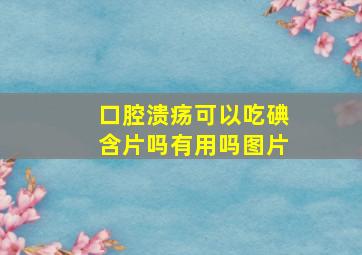 口腔溃疡可以吃碘含片吗有用吗图片