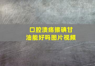 口腔溃疡擦碘甘油能好吗图片视频