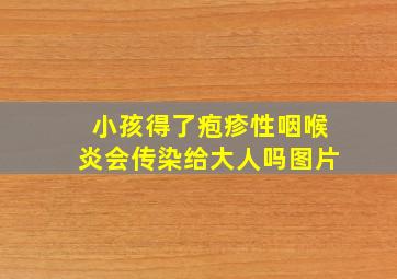 小孩得了疱疹性咽喉炎会传染给大人吗图片