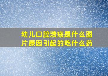 幼儿口腔溃疡是什么图片原因引起的吃什么药