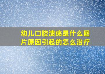 幼儿口腔溃疡是什么图片原因引起的怎么治疗