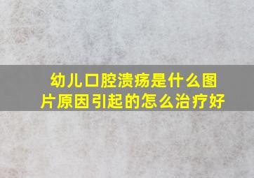 幼儿口腔溃疡是什么图片原因引起的怎么治疗好