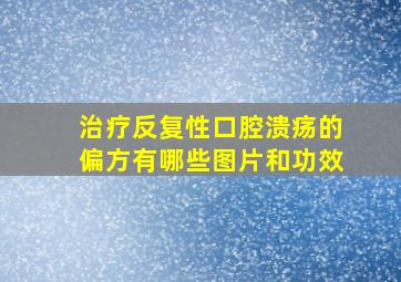 治疗反复性口腔溃疡的偏方有哪些图片和功效