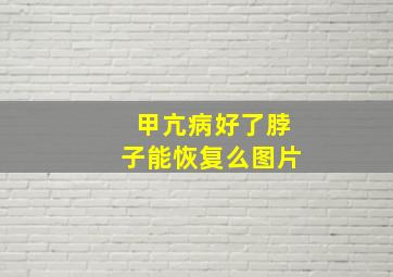 甲亢病好了脖子能恢复么图片