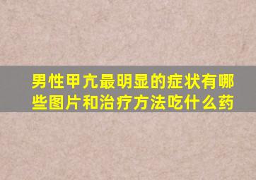 男性甲亢最明显的症状有哪些图片和治疗方法吃什么药