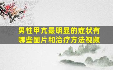 男性甲亢最明显的症状有哪些图片和治疗方法视频