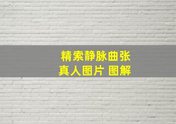 精索静脉曲张真人图片 图解