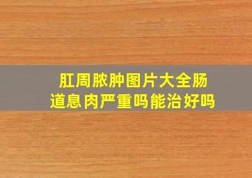 肛周脓肿图片大全肠道息肉严重吗能治好吗