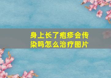 身上长了疱疹会传染吗怎么治疗图片