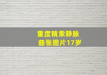 重度精索静脉曲张图片17岁