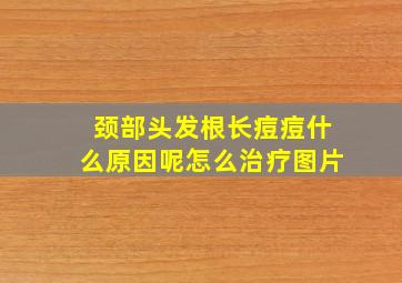 颈部头发根长痘痘什么原因呢怎么治疗图片